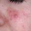 11. Herpes on Cheek Pictures