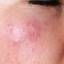 13. Herpes on Cheek Pictures