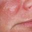 8. Herpes on Cheek Pictures