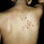 10. Herpes on Back Pictures