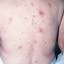 12. Herpes on Back Pictures
