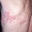 15. Herpes on Back Pictures