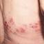 17. Herpes on Back Pictures