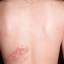 18. Herpes on Back Pictures