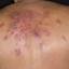 2. Herpes on Back Pictures