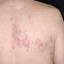 4. Herpes on Back Pictures