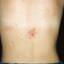 7. Herpes on Back Pictures