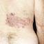 9. Herpes on Back Pictures