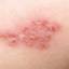 11. Herpes Symptoms Pictures