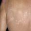 16. Herpes Symptoms Pictures