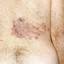 25. Herpes Symptoms Pictures