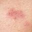 3. Herpes Symptoms Pictures