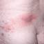 35. Herpes Symptoms Pictures