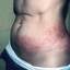 39. Herpes Symptoms Pictures