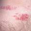 43. Herpes Symptoms Pictures