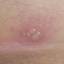 7. Herpes Symptoms Pictures