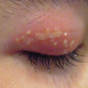 Herpes on Eyelid
