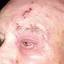 10. Herpes on Eyelid Pictures