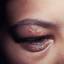 2. Herpes on Eyelid Pictures