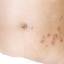 16. Herpes on Stomach Pictures