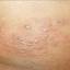 17. Herpes on Stomach Pictures
