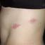 2. Herpes on Stomach Pictures