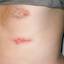 9. Herpes on Stomach Pictures