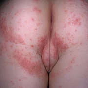 Herpes Symptoms Women