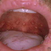 Herpes Throat