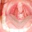 1. Herpes Throat Pictures