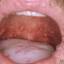 2. Herpes Throat Pictures