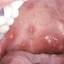 4. Herpes Throat Pictures