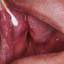 5. Herpes Throat Pictures