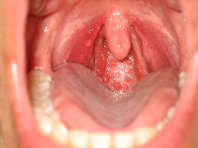 Photo Of Throat 21