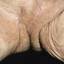 13. Hidradenitis Groin Pictures