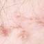 9. Hidradenitis Groin Pictures