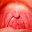 3. Strep Throat Scarlet Fever Pictures