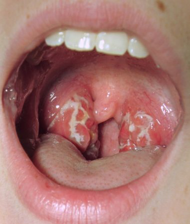 Strep Throat Verses Scarlet Fever 105