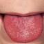 4. Scarlet Fever Tongue Pictures