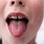 8. Scarlet Fever Tongue Pictures