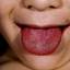 9. Scarlet Fever Tongue Pictures