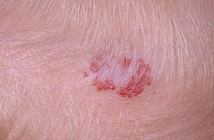 Capillary Hemangioma Pictures 8 Photos And Images