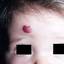 7. Capillary Hemangiomas in Infants Pictures
