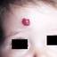 8. Capillary Hemangiomas in Infants Pictures