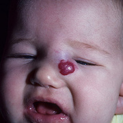 Cavernous Hemangioma in Newborns