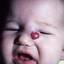 1. Cavernous Hemangioma in Newborns Pictures