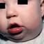 13. Cavernous Hemangioma in Newborns Pictures