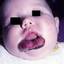 14. Cavernous Hemangioma in Newborns Pictures