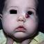 16. Cavernous Hemangioma in Newborns Pictures