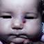 19. Cavernous Hemangioma in Newborns Pictures